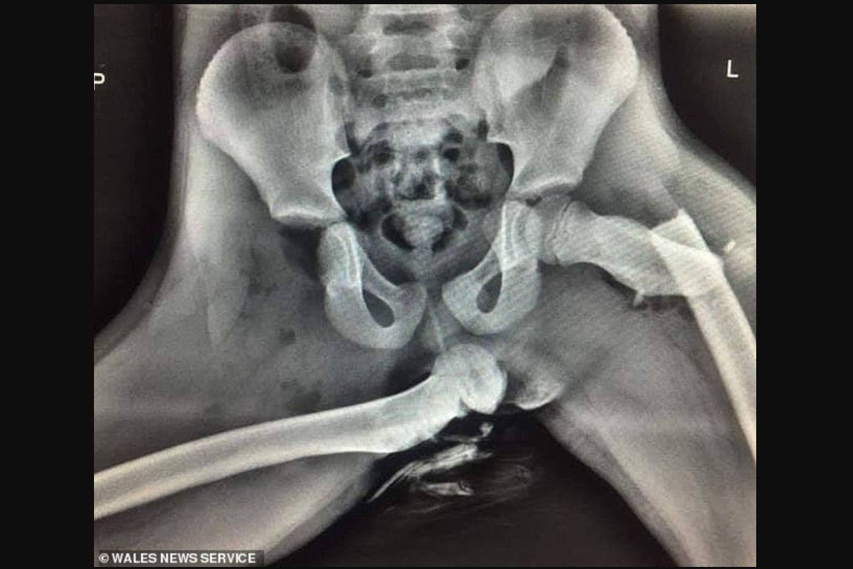 Akibat menaruh kaki di dasbor dan terjadi kecelakaan